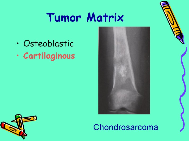 Osteoblastic Cartilaginous Tumor Matrix Chondrosarcoma